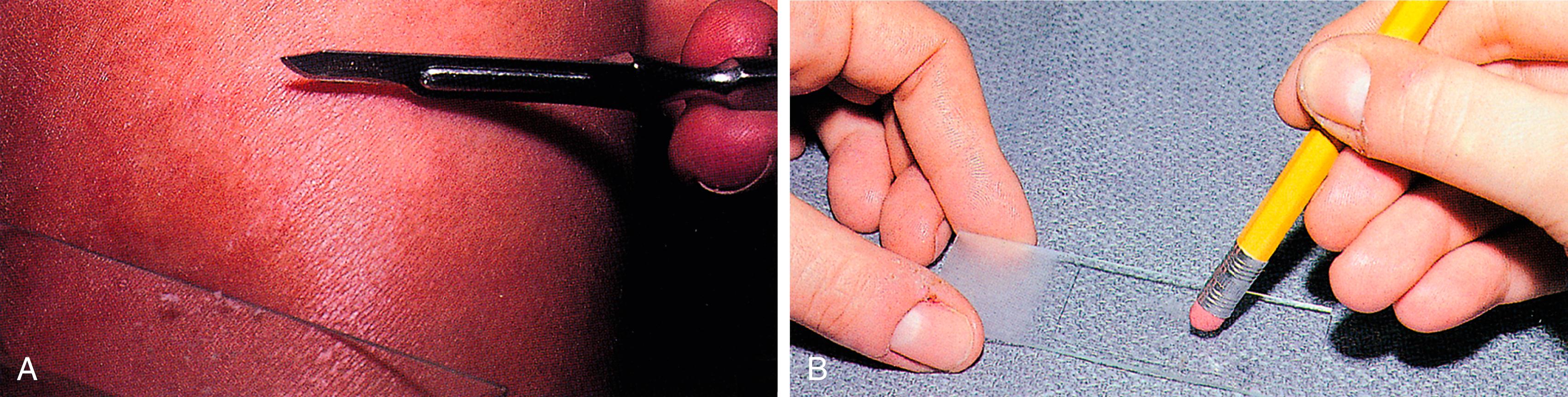 Fig. 8.37, Potassium hydroxide preparation. (A) Small scales should be scraped from the edge of the lesion onto a microscope slide. (B) To more easily visualize the fungus, the scales should be crushed, making a thin layer of cells.