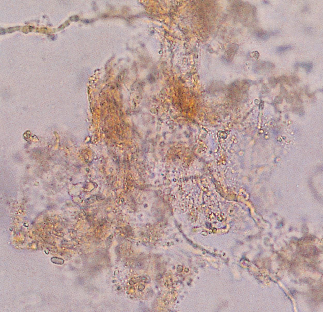 Fig. 8.38, Positive potassium hydroxide preparation of skin scrapings. Fungal hyphae are seen as long septate branching rods at the margins and center of the scales.