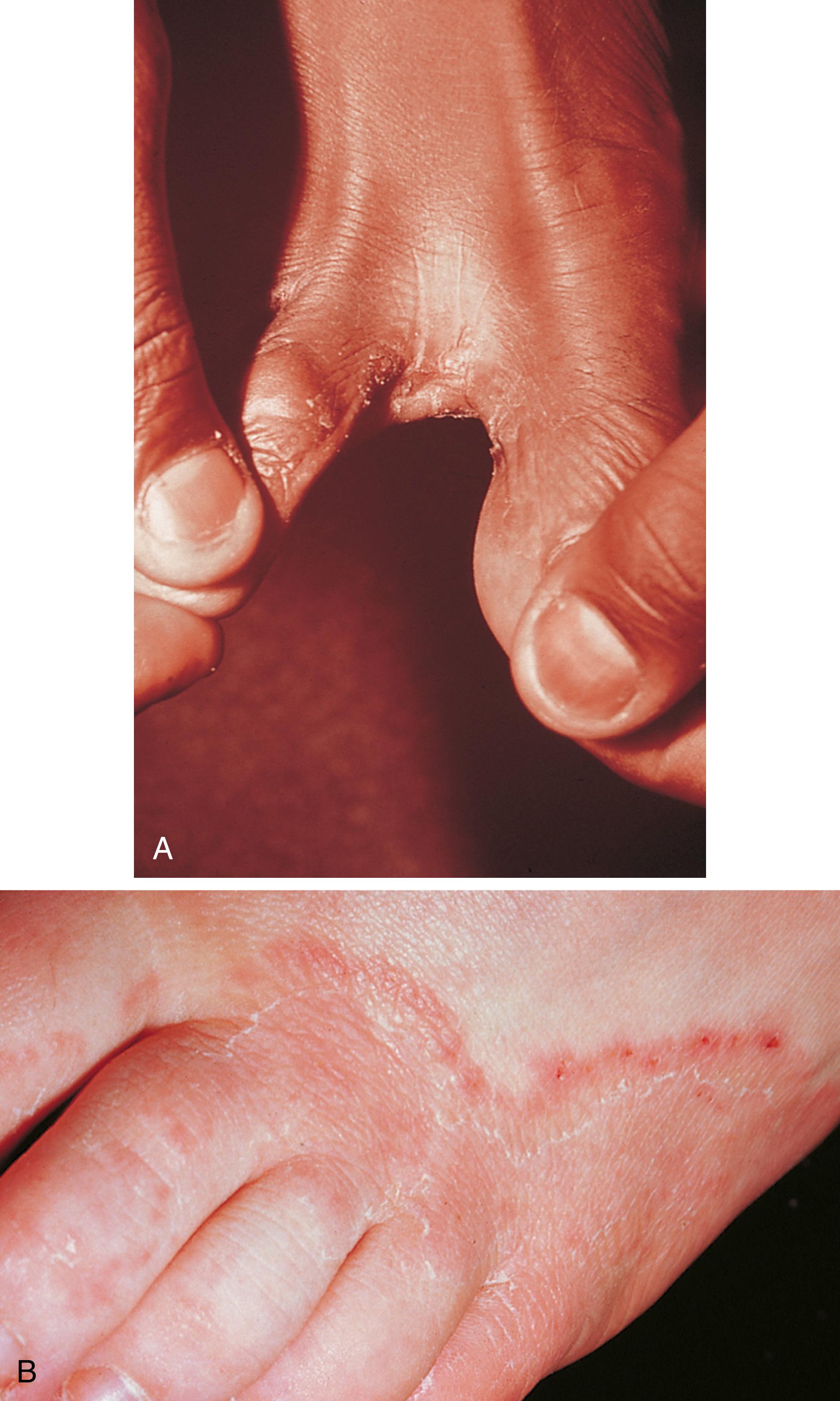 Fig. 8.39, Tinea pedis. (A) Cracking and scaling are seen in the web space. (B) In this patient, the lesions began in the web spaces but then extended onto the dorsum of the foot. Note the active border.