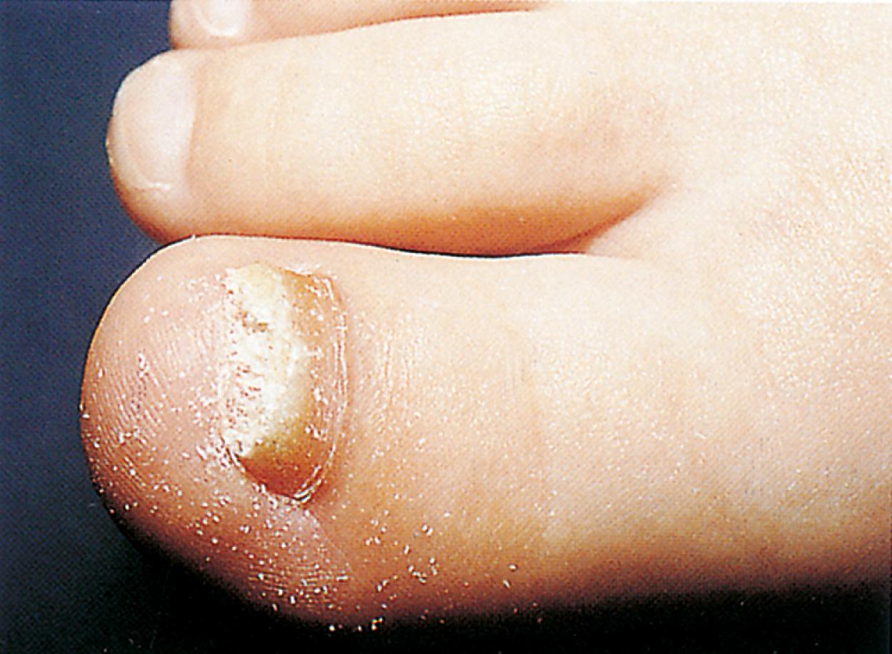 Fig. 8.136, Onychomycosis caused by a chronic dermatophyte infection of the nail plate in a 4-year-old boy. This is relatively rare in prepubertal children.