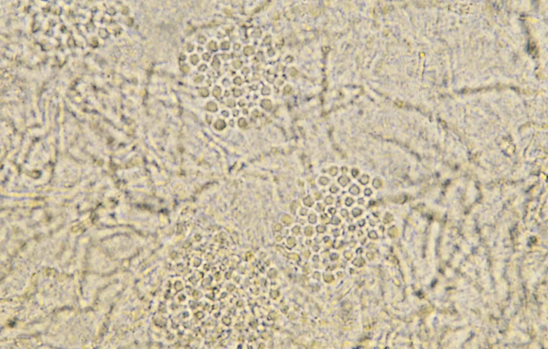 Fig. 8.41, Positive potassium hydroxide preparation for tinea versicolor. The combination of hyphal and yeast forms of the fungus simulates the appearance of spaghetti and meatballs.