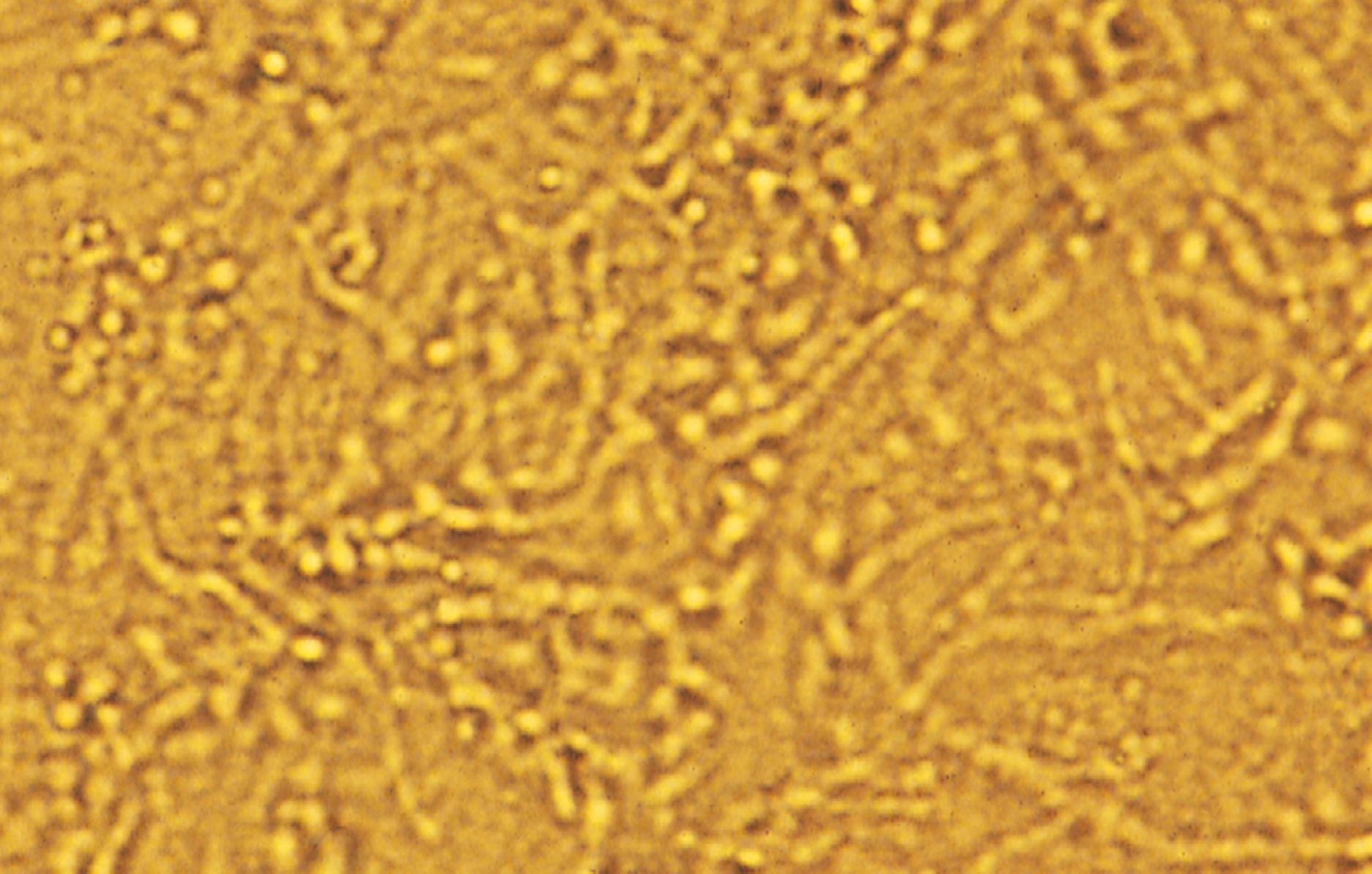 Fig. 8.44, Potassium hydroxide preparation of skin scrapings from an infant with candidal diaper dermatitis demonstrating pseudohyphae and spores.