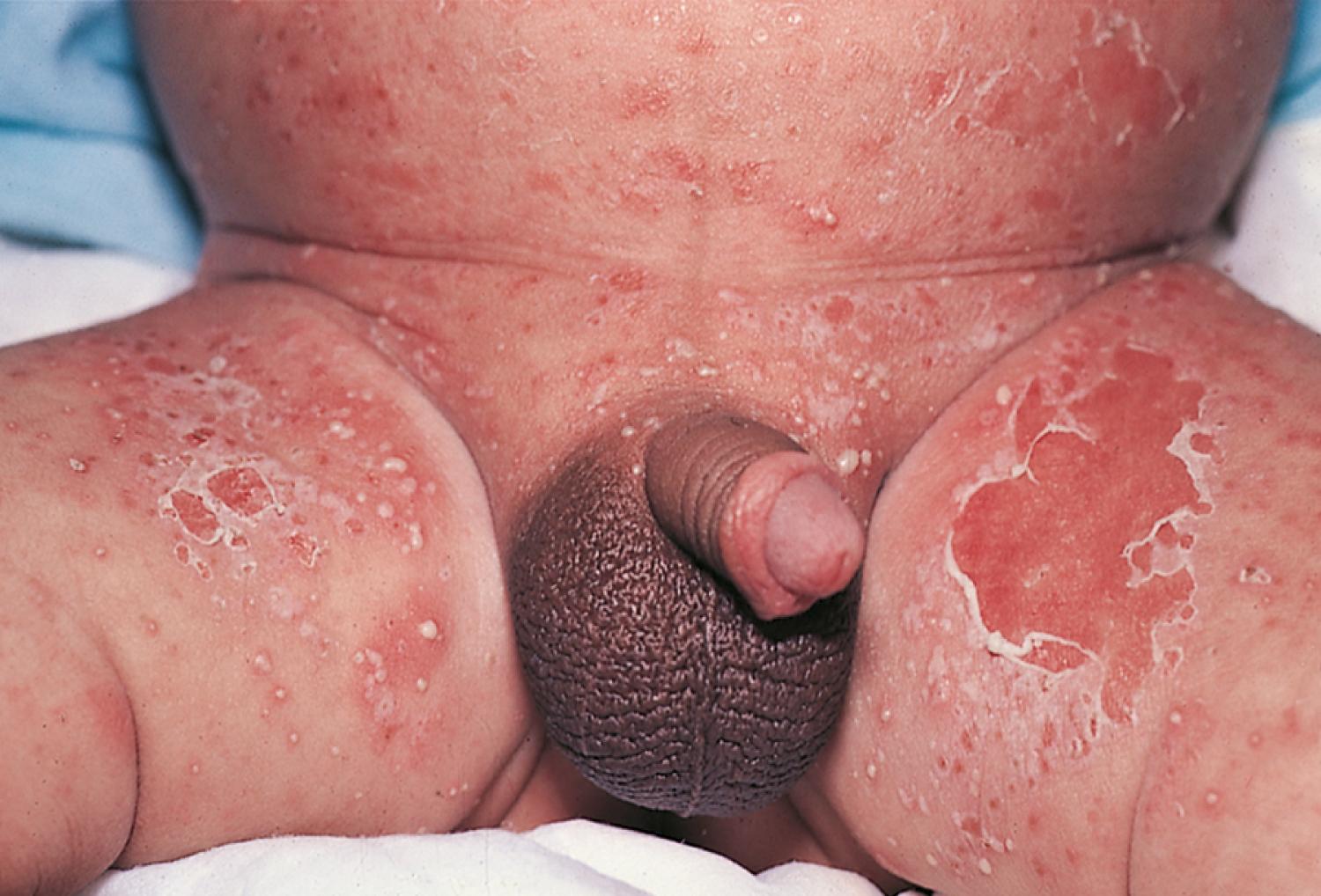 Fig. 8.45, Staphylococcal diaper dermatitis. Numerous thin-walled pustules are surrounded by erythematous halos, as well as multiple areas in which pustules have ruptured, leaving a collarette of scale around a denuded erythematous base.