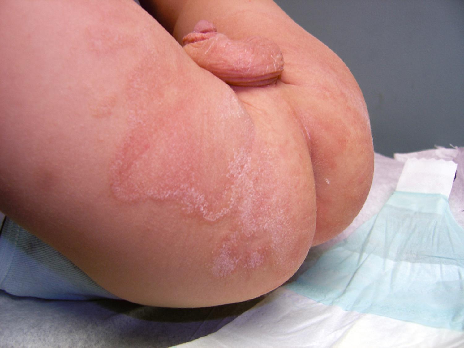 Fig. 8.48, Tinea diaper dermatitis. Note the prominent scaling and the elevated active border.