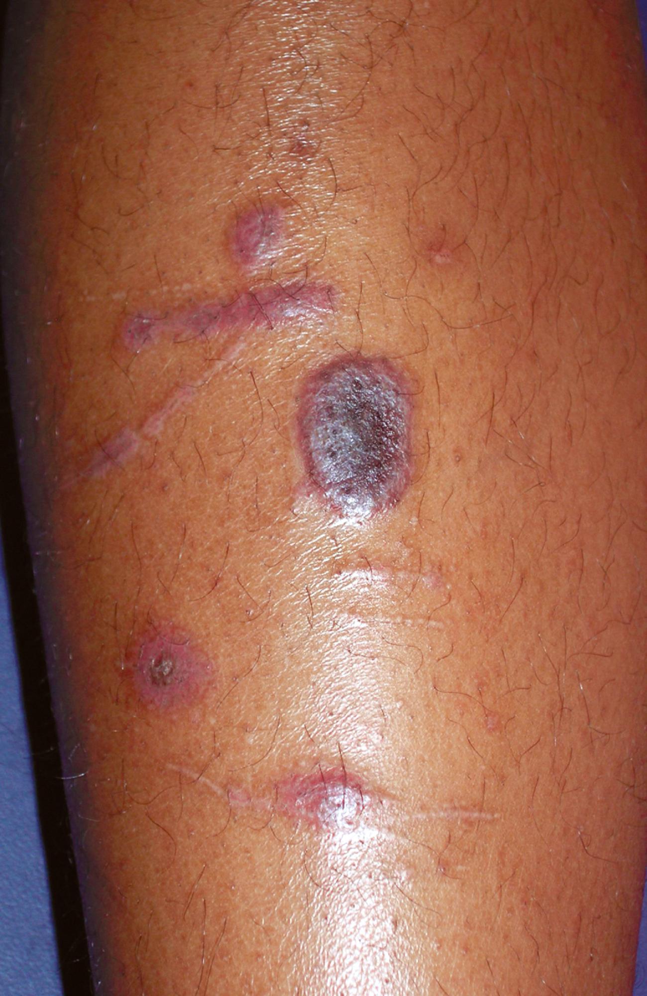 Fig. 8.49, Lichen planus. These flat-topped violaceous papules of varying sizes and shapes overlying the anterior shin are typical. Note the linear lesions that formed after scratching, examples of the Koebner phenomenon.