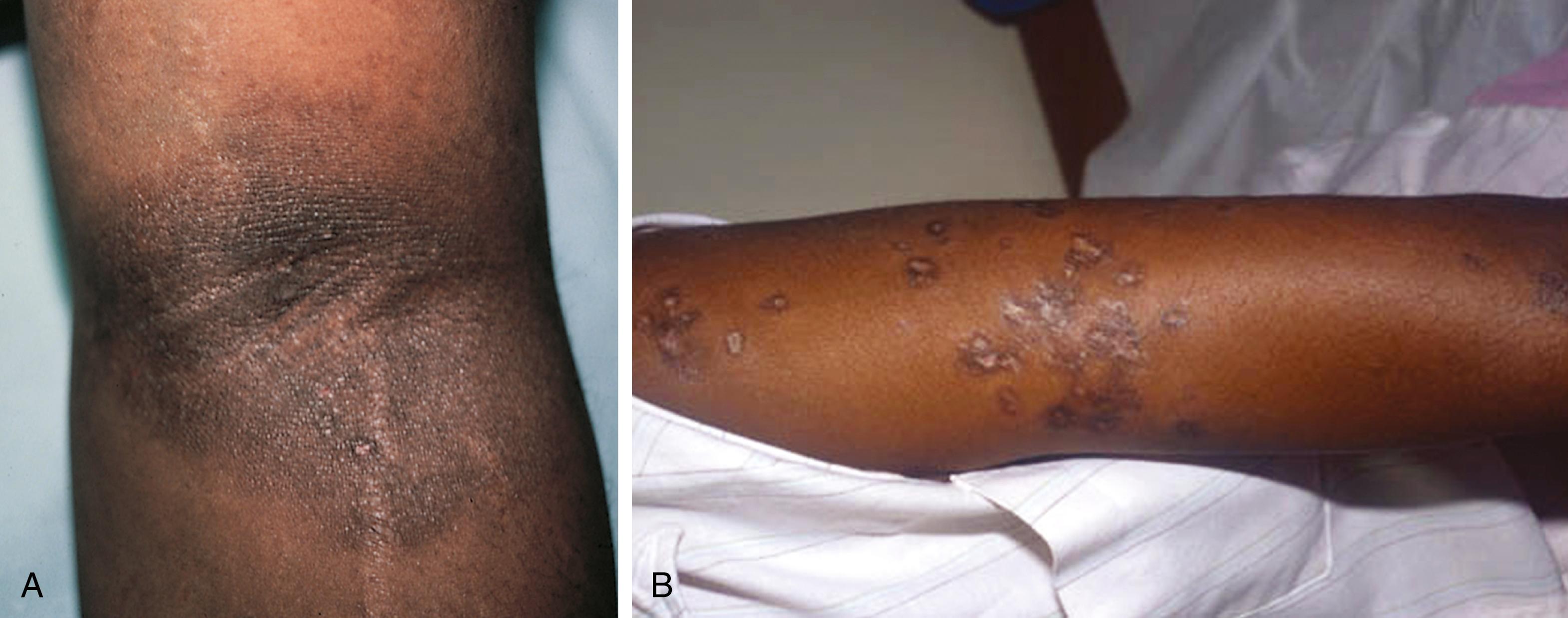 Fig. 8.116, (A) Postinflammatory hyperpigmentation arose in a child with chronic atopic dermatitis, which provoked persistent scratching. (B) This patient with discoid lupus provides another example of the phenomenon.