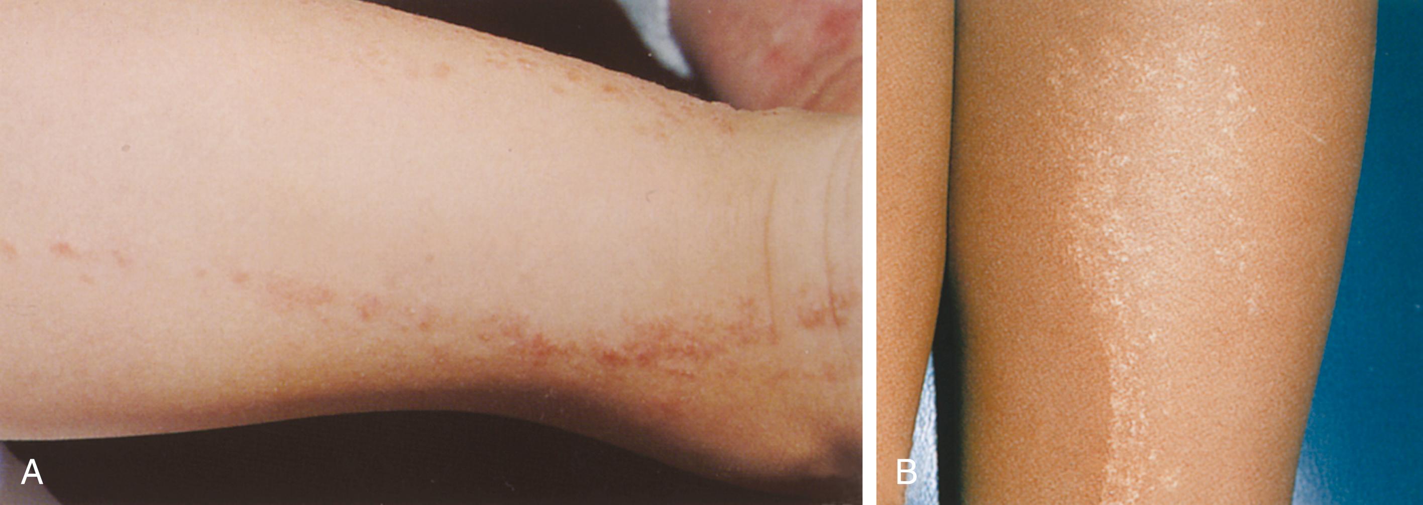 Fig. 8.50, Lichen striatus. (A) In this school-age child, mildly erythematous scaly flat-topped papules are seen in a linear distribution on the lower leg. (B) Another child with darker skin has lesions that are hypopigmented on the posterior thigh.