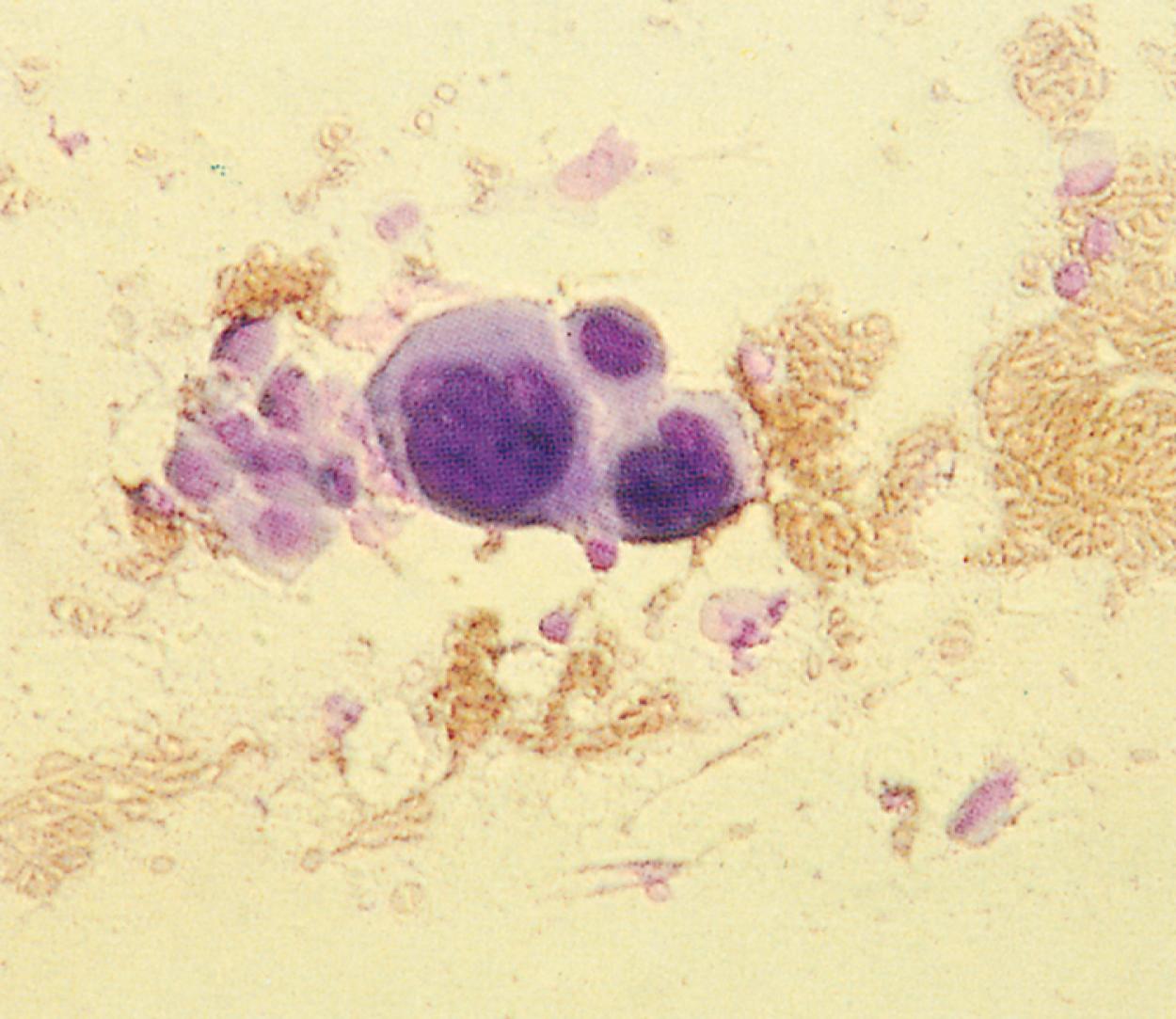 Fig. 8.51, Tzanck preparation. Note the multinucleated giant cell characteristic of viral infection with herpes simplex and varicella-zoster.