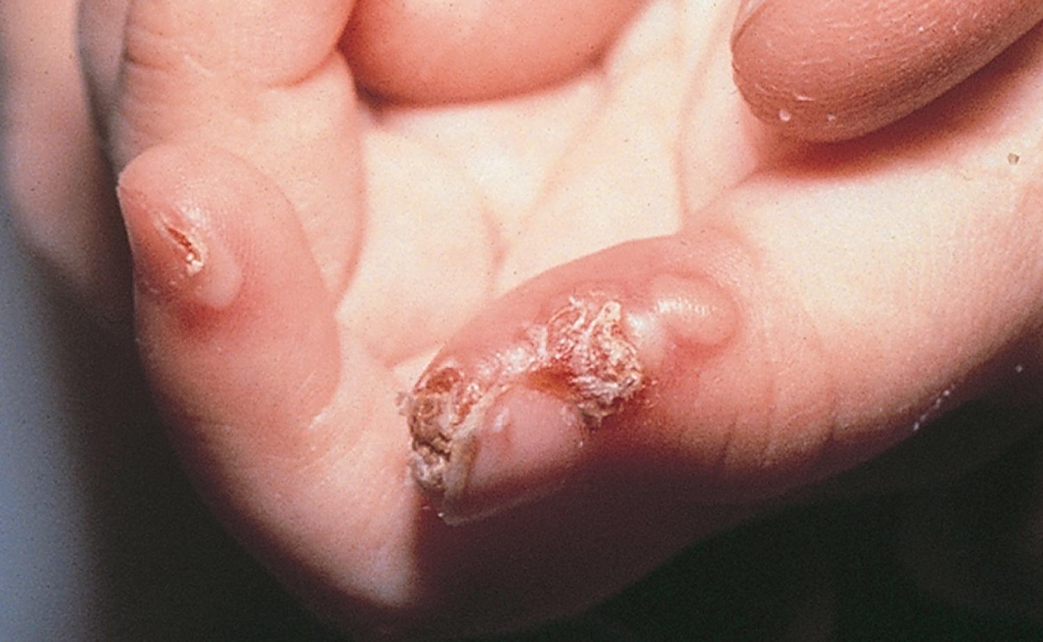 Fig. 8.52, Blistering distal dactylitis. A tense blister filled with purulent fluid first developed at the tip of the thumb pad of this child. Subsequently, the lesion ruptured and crusted and newer lesions formed more proximally along the nail fold and at the tip of the index finger.