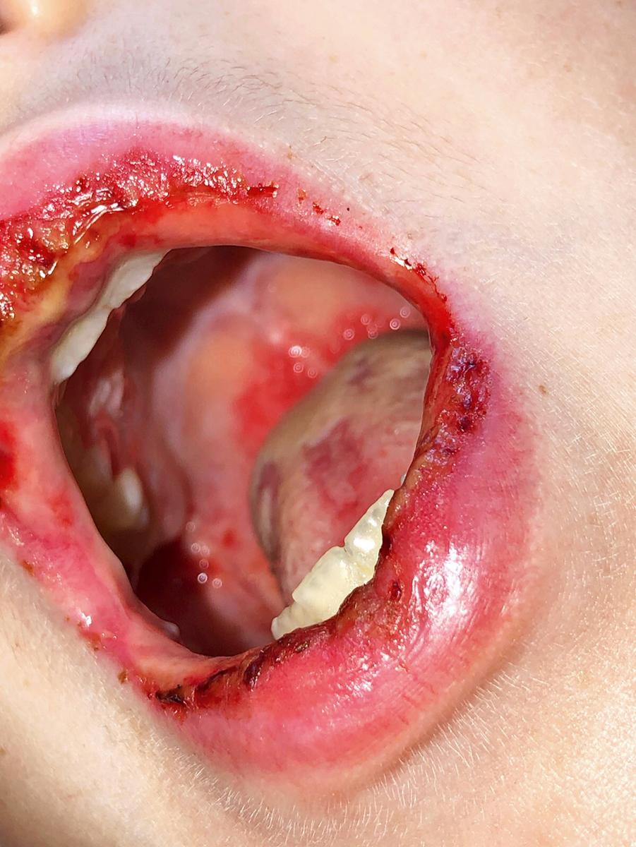 Fig. 8.53, Mycoplasma -induced rash and mucositis. This adolescent male developed a severe oral mucositis with hemorrhagic crusting. Severe conjunctivitis is also commonly seen, with variable cutaneous involvement.