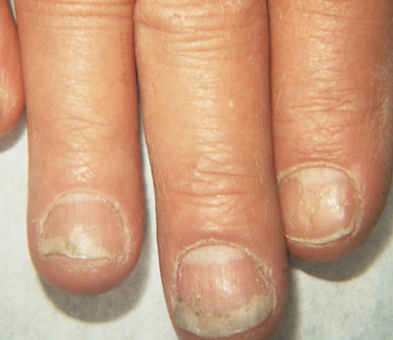 Fig. 8.140, Psoriatic nails. Psoriasis affecting the nails results in onycholysis and pitting.