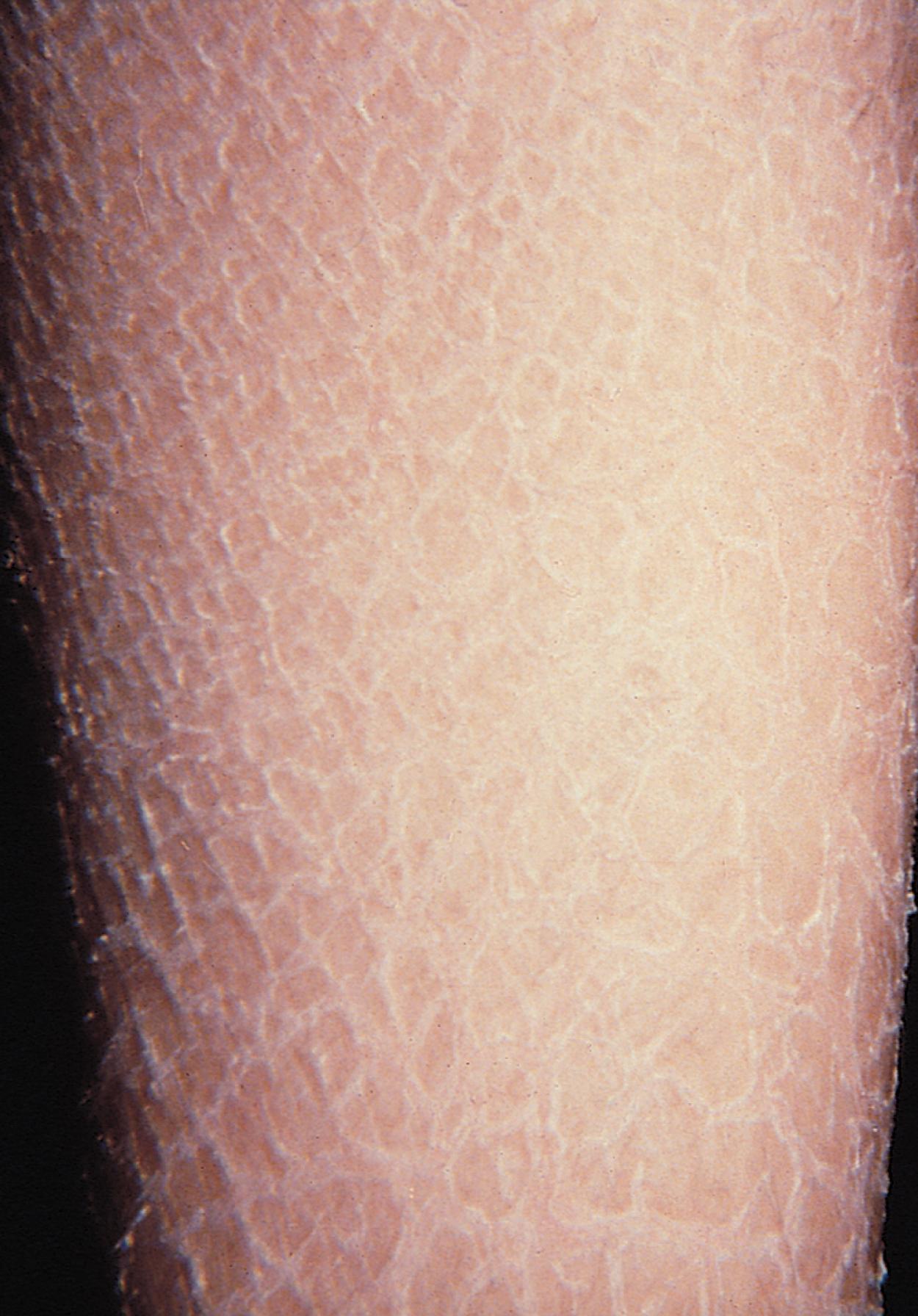 Fig. 8.7, Ichthyosis vulgaris. The typical fish scale appearance is seen in this close-up of a fair-skinned patient’s shin.