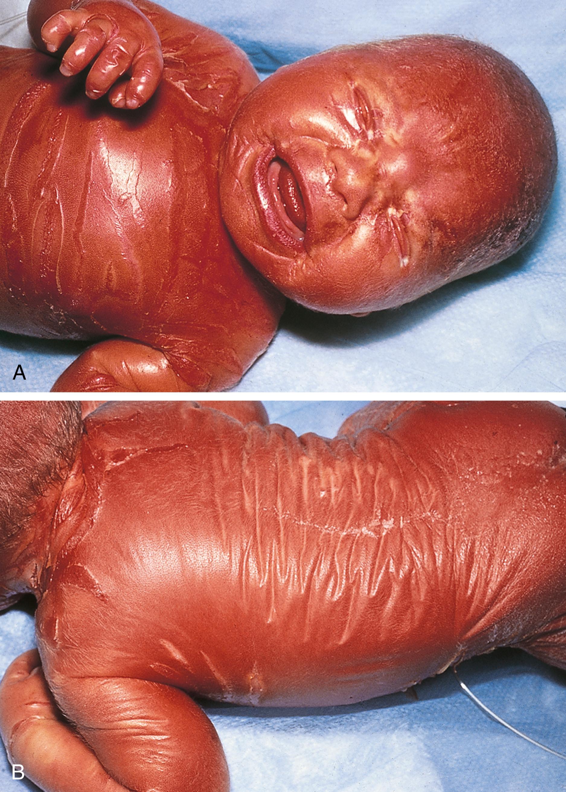 Fig. 8.96, Collodion baby. (A and B) A shiny transparent membrane covered this baby at birth; she later developed lamellar ichthyosis. Note the ectropion and eclabium (eversion and fissuring of the eyelid margins and lips).