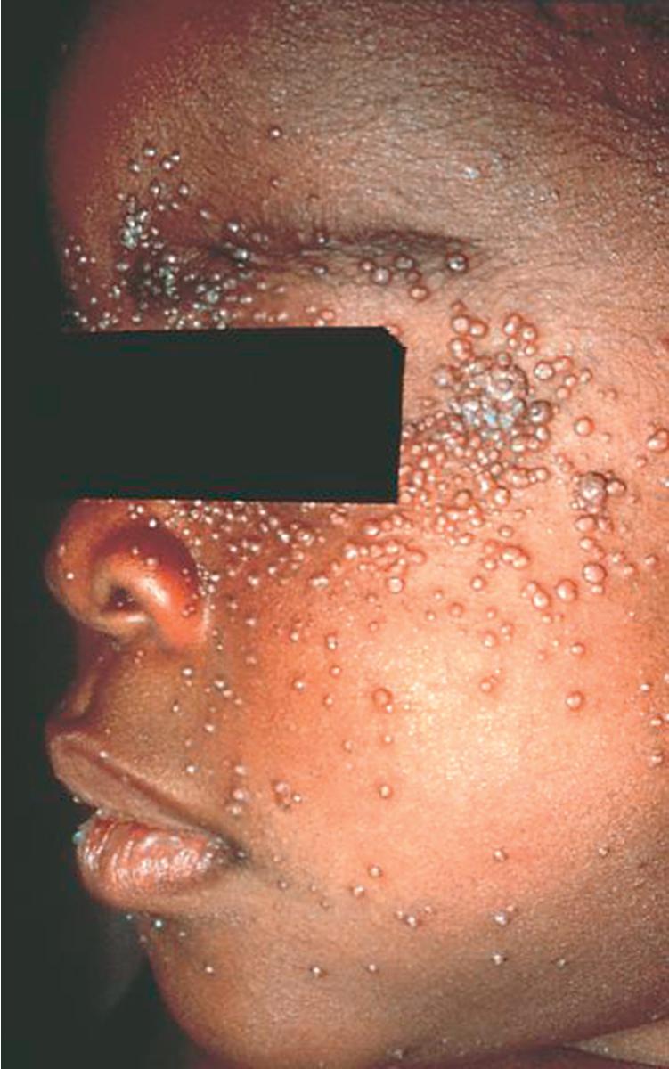 Fig. 55.12, Severe Molluscum Contagiosum in a Patient with AIDS.