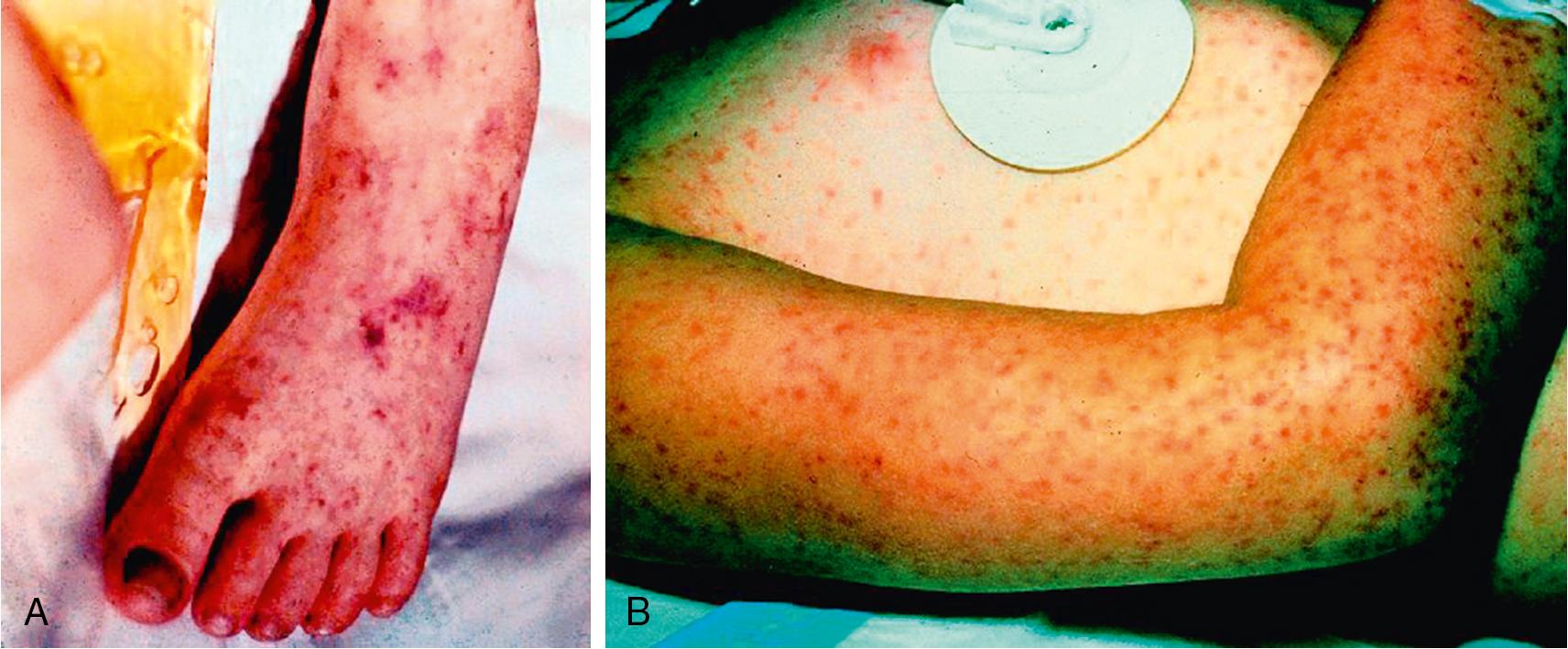 Fig. 55.13, Rocky Mountain Spotted Fever.