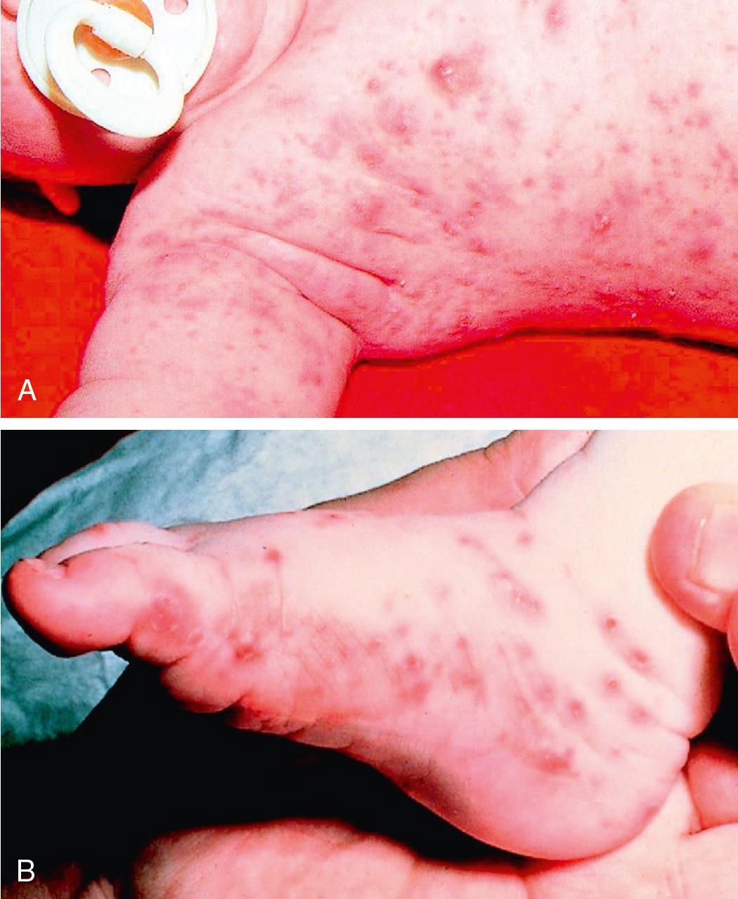 Fig. 55.15, Infantile Scabies.