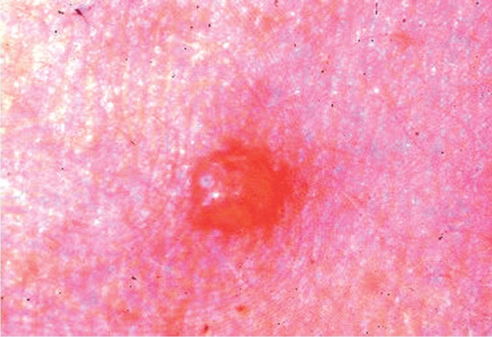 Fig. 55.4, Varicella/Chickenpox.