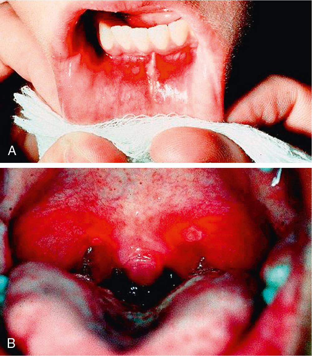 Fig. 55.8, Coxsackievirus Hand, Foot, and Mouth Disease.