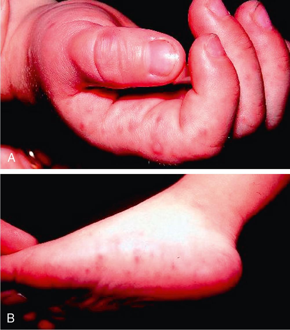 Fig. 55.9, The Exanthem of Coxsackievirus Hand, Foot, and Mouth Disease.