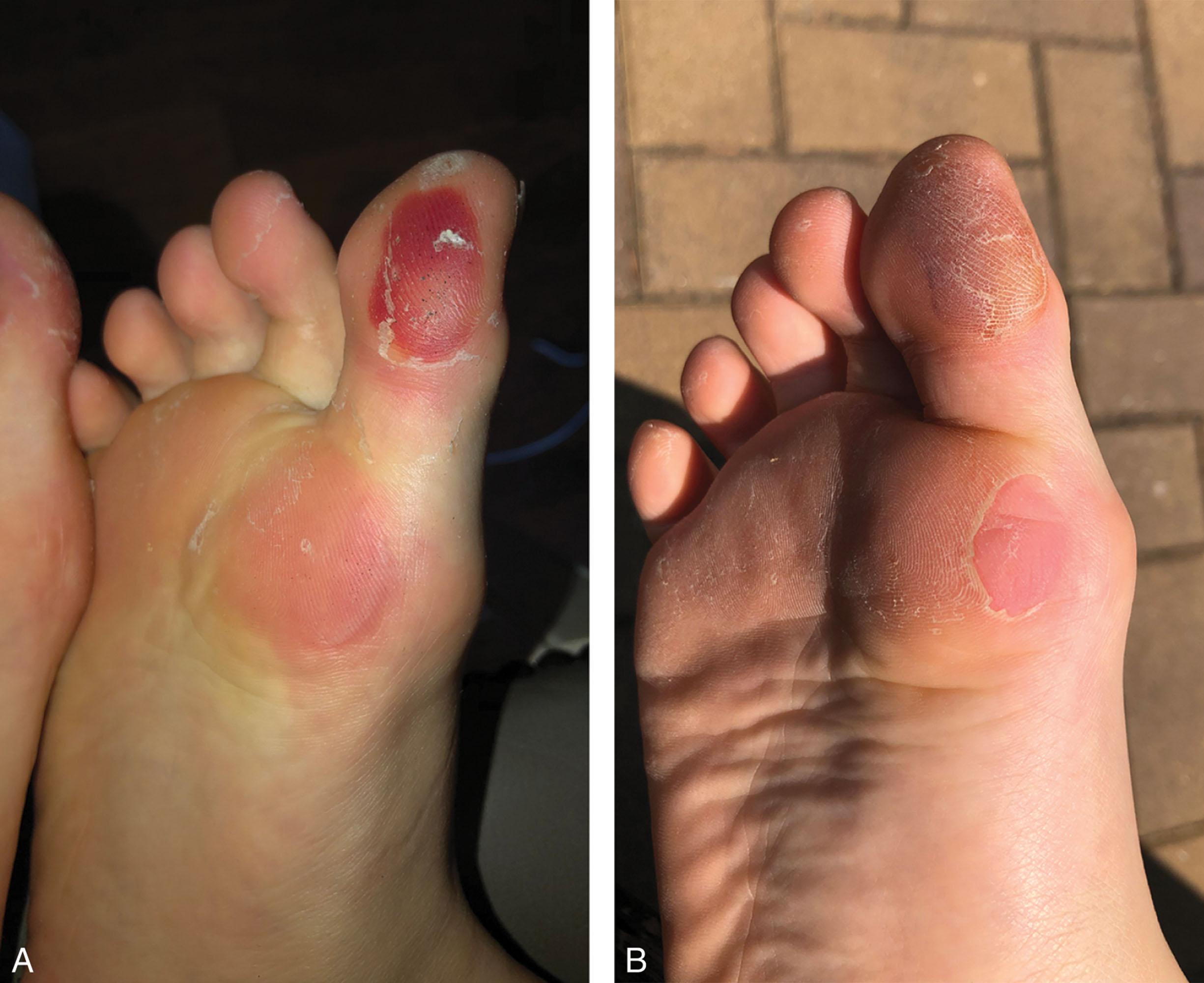 Fig. 16-1, A , Blister caused by ill-fitting shoes on the plantar medial first toe and metatarsal base. B , After a week, the area becomes hyperkeratotic in response to the trauma.