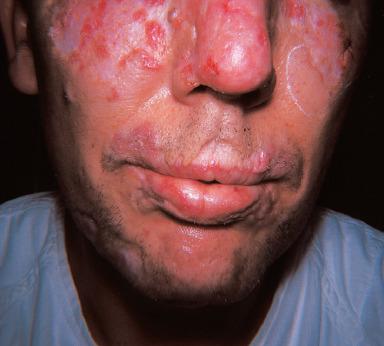 Figure 2.11, Extensive facial lesions of chronic discoid lupus erythematosus.