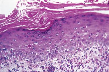 Figure 2.12, Lesion of chronic discoid lupus erythematosus showing hyperkeratosis and interface change with hydropic degeneration along basal layer.