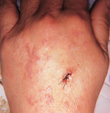 Figure 2.13, Clinical Appearance of Lichen Planus Affecting the Dorsum of the Hand.