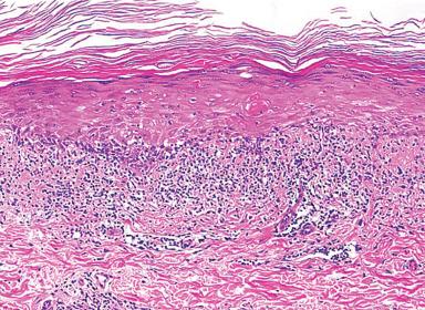 Figure 2.14, Microscopic Appearance of Lichen Planus.