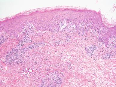 Figure 2.17, Pityriasis Lichenoides Et Varioliformis Acuta.