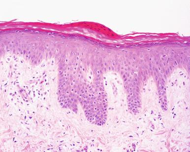 Figure 2.3, Chronic Spongiotic Dermatitis.