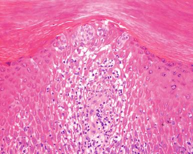 Figure 2.4, Langerhans Cell Microabscess.