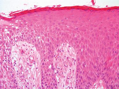 Figure 2.5, Stasis Dermatitis.