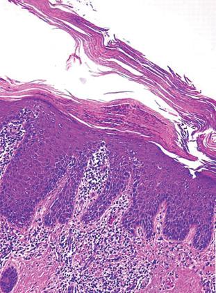 Figure 2.6, Typical Appearance of Psoriasis.