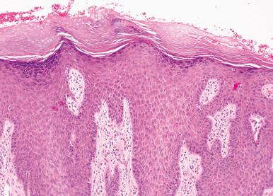 Figure 2.8, Lichen Simplex Chronicus.