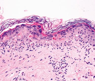 Figure 2.9, Erythema Multiforme.