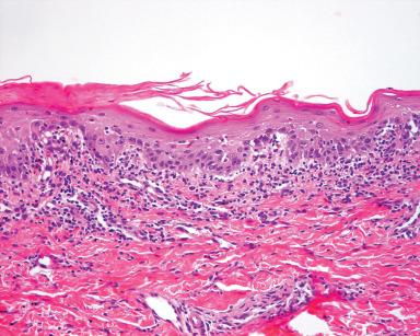 Figure 2.10, Microscopic changes of acute graft-versus-host reaction.