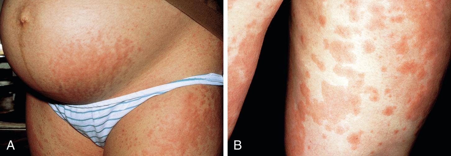 Fig. 59.1, Polymorphic eruption of pregnancy (PEP). A, Erythematous papules in the striae of a 21-year-old primigravida woman. B, Urticarial papules and plaques that are not associated with striae on the thighs of a woman with PEP.