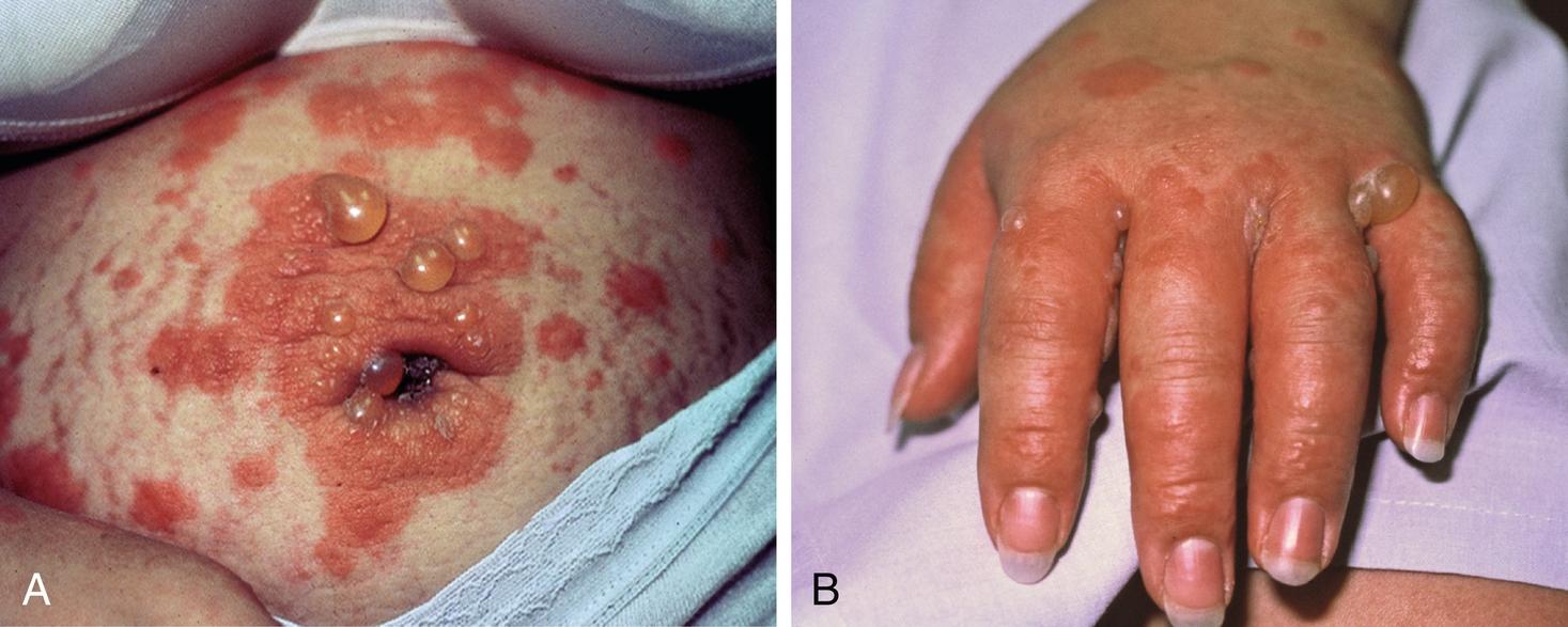 Fig. 59.2, Pemphigoid gestationis. A, Umbilical urticarial plaques and tense blisters in a woman with pemphigoid gestationis. B, Intertriginous area between fingers demonstrating tense blisters. This is another commonly affected site in pemphigoid gestationis.