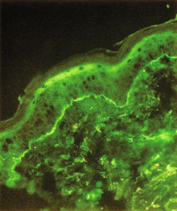 Fig. 59.3, Pemphigoid gestationis. Direct immunofluorescent study demonstrating linear C3 along the basement membrane zone. Less commonly, linear immunoglobulin G is also seen.