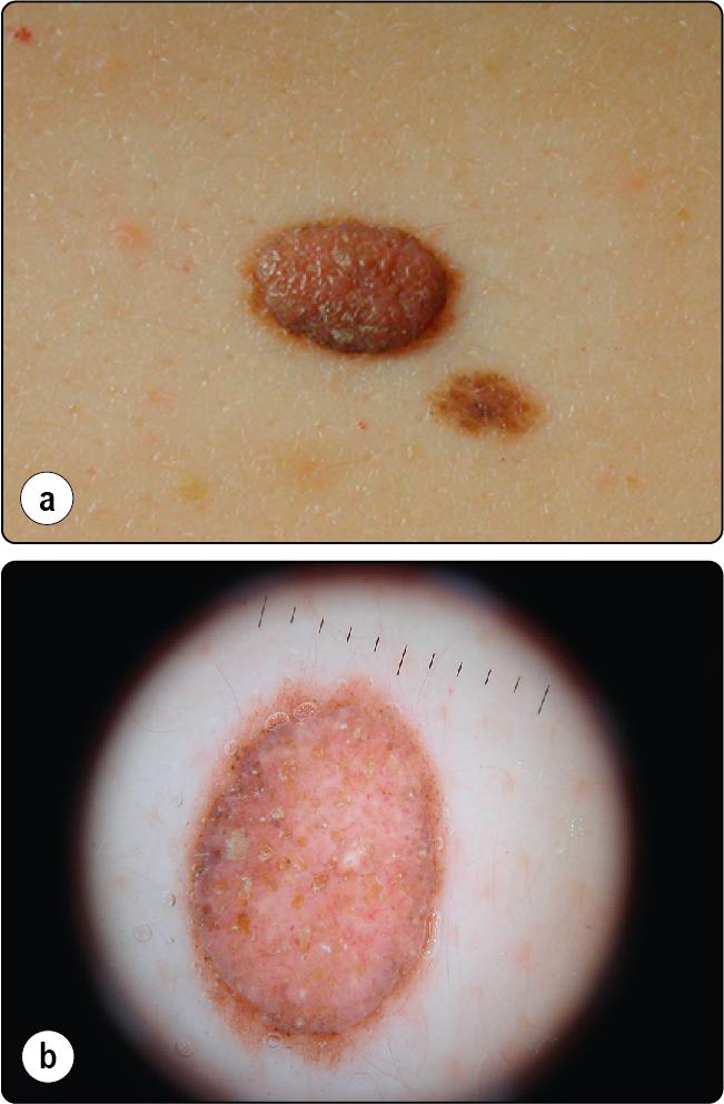 Fig. 11.1, Macroscopic (a) and dermoscopic image (b) of benign melanocytic naevus showing symmetrically distributed colours around a central amorphous area.
