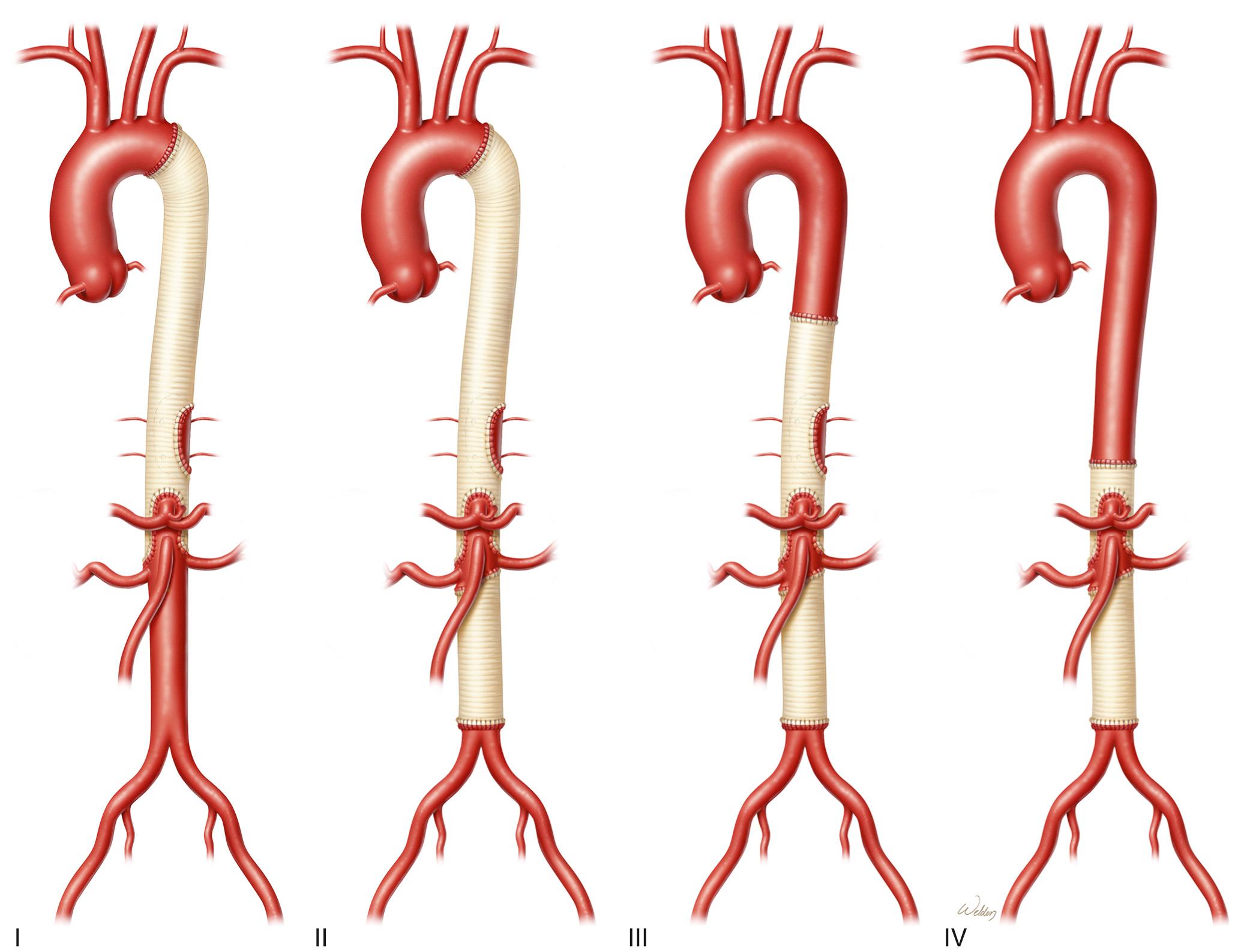 FIGURE 69-1, The Crawford classification system for describing the extent of thoracoabdominal aortic aneurysm repair.