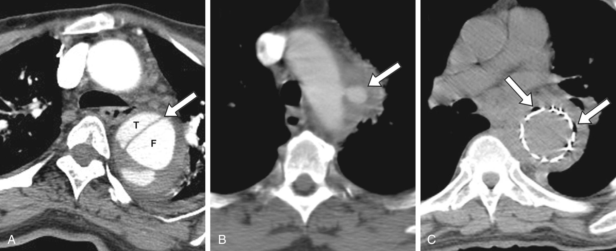 FIGURE 69-2, Computed tomography scans showing key diagnostic findings. A, Chronic distal aortic dissection; the dividing septum is relatively straight (arrow), and the true (T) and false (F) lumens are indicated. B, Mycotic aneurysm, which is saccular in shape (arrow). C, Infection of an endograft; gas bubbles, indicated by arrows, may be seen near the endograft.