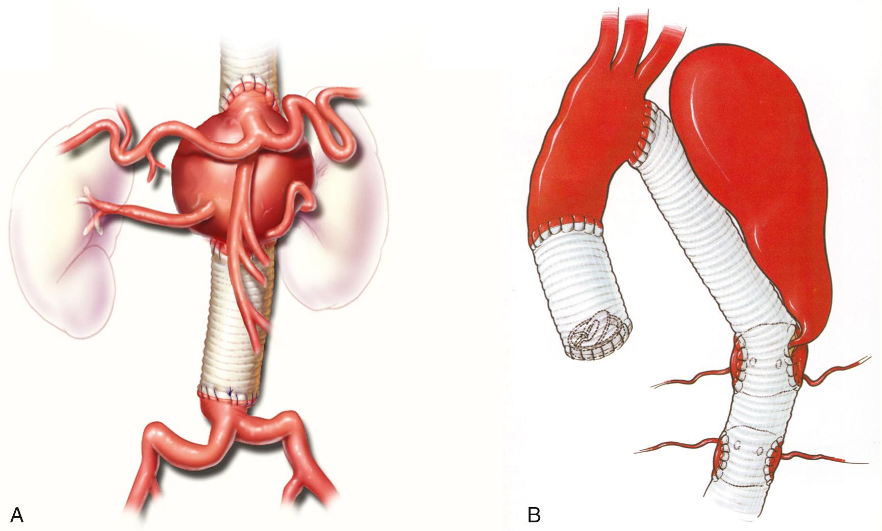 FIGURE 69-3, Illustration showing late complications of open aortic repair. A, A visceral patch aneurysm has developed in the residual native aortic tissue. B, A pseudoaneurysm has developed near the suture line of an intercostal artery reattachment site.