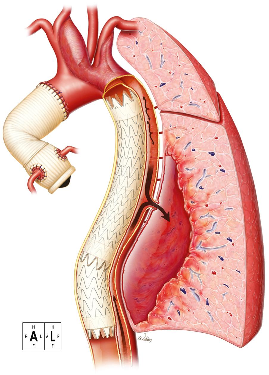 FIGURE 69-4, Illustration showing the development of an aortopulmonary fistula, a rare late complication of thoracic endovascular aortic repair. Here, the stent-graft is shown to be within the true lumen. The distal descending thoracic aorta has ruptured into the lower lobe of the left lung (arrow); the false lumen continued to be perfused from re-entry sites below the distal landing zone of this stent-graft. Blood flow from collateral vessels additionally perfused the false lumen.