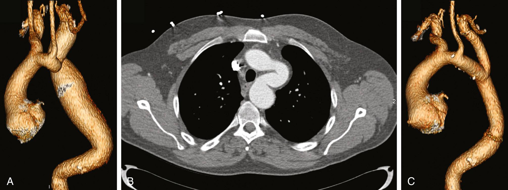 FIGURE 69-5, Computed tomographic angiograms in a patient with bicuspid aortic valve, related proximal and distal aortopathy, and coarctation. A, Three-dimensional reconstruction showing coarctation of the descending thoracic aorta. B, Axial image showing hypoplasia and tortuosity of the aortic arch. C, Post-repair three-dimensional reconstruction showing surgical correction of the aortic arch, descending thoracic aorta, and the left subclavian artery.