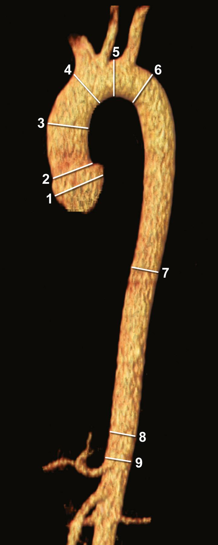 FIGURE 69-6, Current practice guidelines 43 seek to standardize the reporting of aortic diameters by indicating key anatomic locations to be measured. These include (1) the sinuses of Valsalva, (2) the sinotubular junction, (3) the mid-ascending aorta, (4) the proximal aortic arch at the origins of the innominate artery, (5) the mid-aortic arch, which is between the left common carotid and left subclavian arteries, (6) the proximal descending thoracic aorta, which begins at the isthmus (approximately 2 cm distal to the origins of the left subclavian artery), (7) the mid-descending thoracic artery, (8) the aorta at the diaphragm, and (9) the abdominal aorta at the origins of the celiac axis.