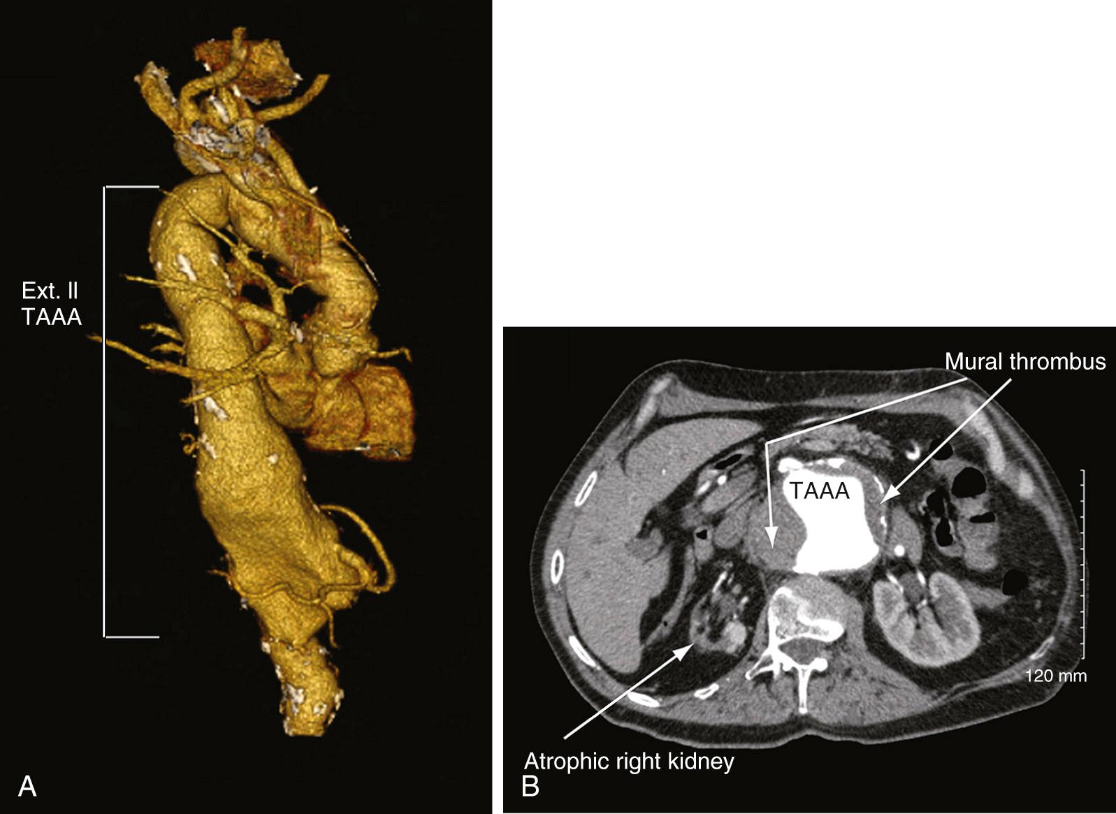 FIGURE 69-7, Three-dimensional reconstruction (A) and axial contrast-enhanced computed tomographic image (B) of a thoracoabdominal aortic aneurysm (TAAA). Note that the aneurysm is lined with thrombus and that the right kidney is severely atrophic (arrows).