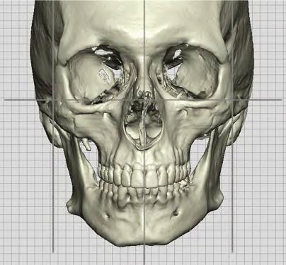 Fig. 14.1, Three-dimensional CT scan of the facial skeleton showing complex mandible asymmetry.