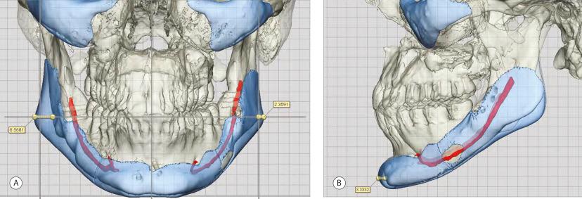 Fig. 14.2, CAD/CAM implant allows desired width, vertical elongation, and sagittal projection of the chin as well as correcting body asymmetry. (A) Frontal view. (B) Lateral view.