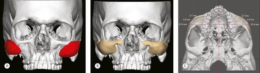 Fig. 14.3, CT scan examples of off-the-shelf and CAD/CAM implants. (A) Frontal view of a three-dimensional CT scan revealing asymmetric position of malar implants. (B) Frontal view of CAD/CAM malar implants. Note symmetric placement. (C) Worm’s eye view of CAD/CAM implants that allow symmetry of implant position, as well as symmetry of combined implant plus underlying skeleton projection.